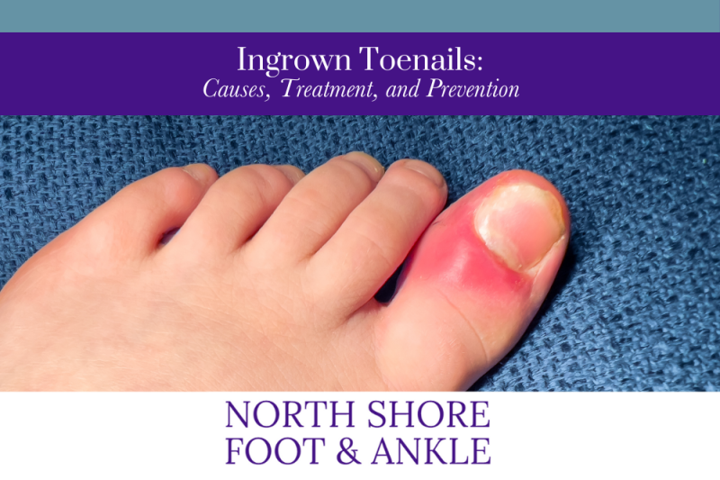 Ingrown Toenails Causes, Treatment, and Prevention