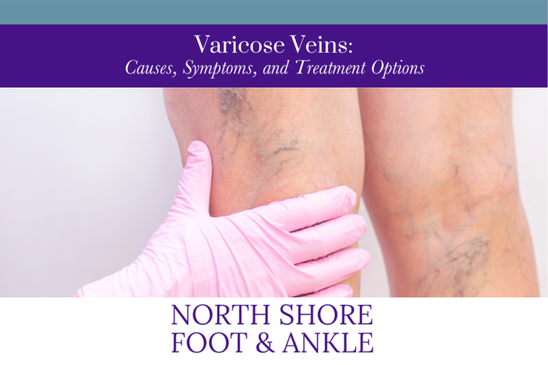 Varicose Veins: Causes, Symptoms, and Treatment Options