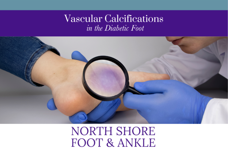 Vascular Calcifications in the Diabetic Foot