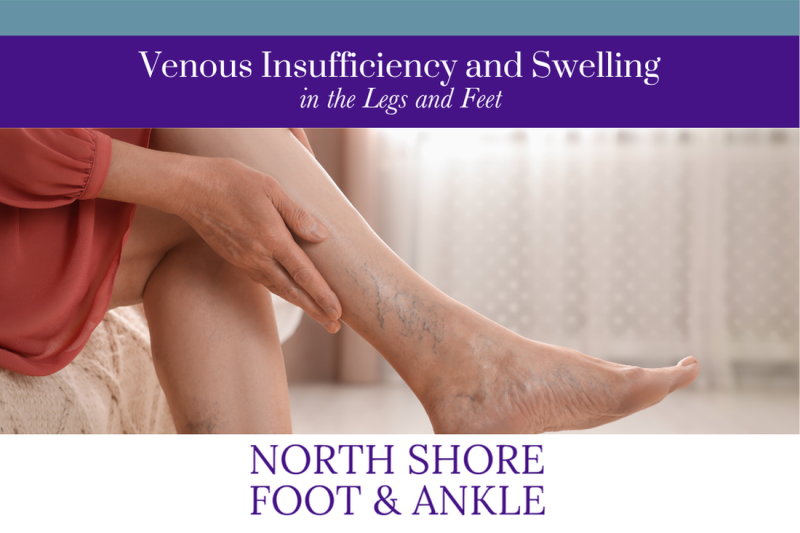 Venous Insufficiency and Swelling in the Legs and Feet
