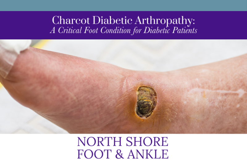Charcot Diabetic Arthropathy A Critical Foot Condition for Diabetic Patients Revised
